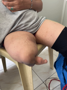 Congenital partial absence of the right lower limb